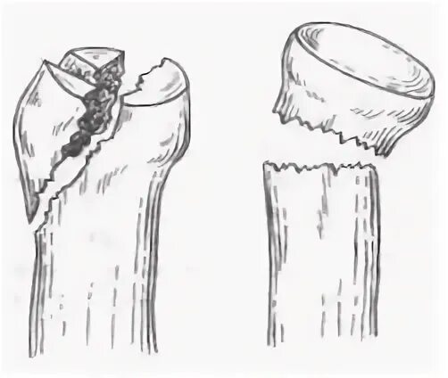 перелом головки лучевой кости кт. перелом головки лучевой кости локтевого сустава. перелом головки и шейки лучевой кости. перелом головки и шейки лучевой кости рентген. перелом правой лучевой головки.