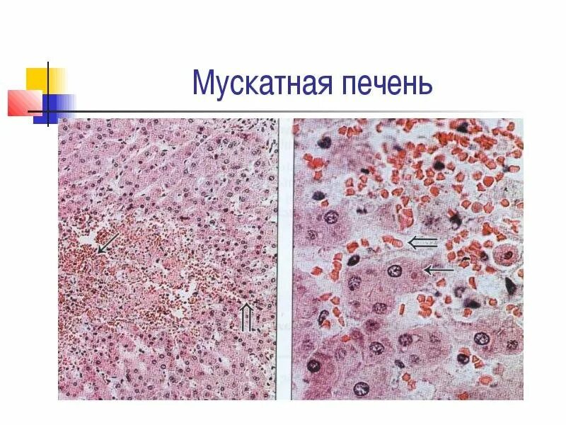 Печень при хроническом венозном застое. Венозное полнокровие печени мускатная печень. Мускатная печень патанатомия. Венозное полнокровие печени гистология. Мускатная печень препарат патанатомия.