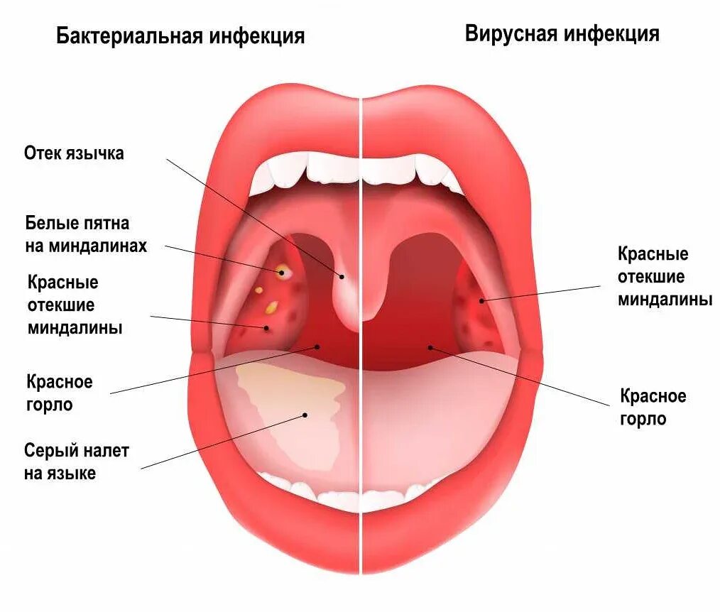 Гнойная ангина стрептококковая. Вирусная и бактериальная ангина. Первичные и вторичные тонзиллиты. Укажите условия возникновения ангины.