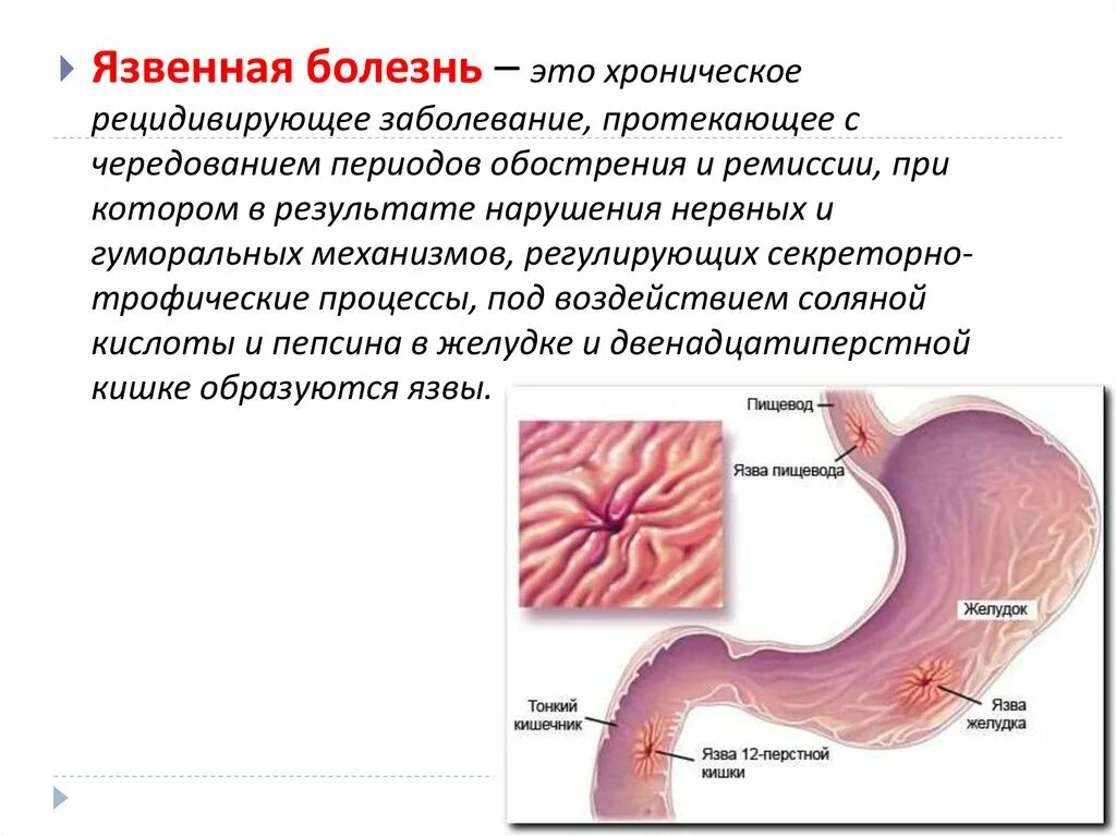 Терапия язвенной болезни 12 перстной кишки. Язвенная болезнь 12 перстной кишки кишки. Язвенная болезнь 12 перстной кишки симптомы. Желудок и луковица 12 перстной кишки. Размеры язвы желудка