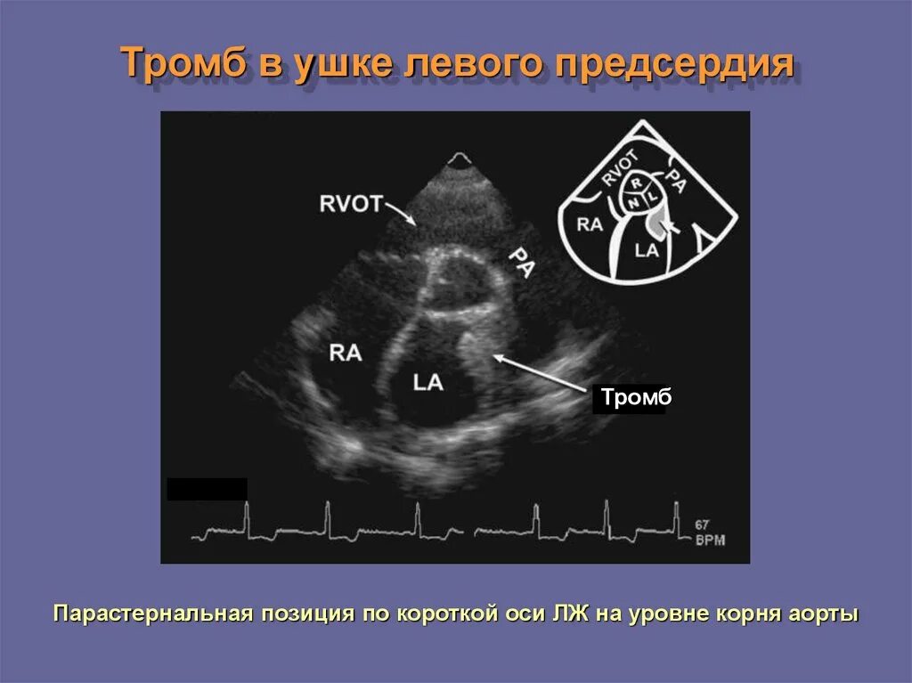 Образование левого предсердия. Тромб ушка левого предсердия на УЗИ. Ушко левого предсердия ЭХОКГ. Тромб в левом предсердии ЭХОКГ. Пролапс митрального клапана протокол эхокардиографии.