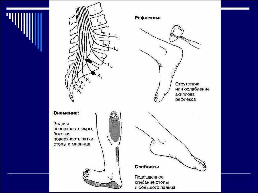 Отсутствие ахиллова рефлекса. Онемела тыльная поверхность стопы. Неврологические синдромы шейного остеохондроза. Неврологические боли в ногах