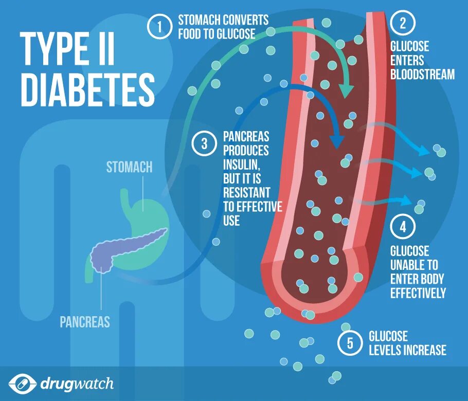 Type 2 Diabetes. Diabetes Types. Type 2 Diabetes mellitus. Type 2 Diabetes mellitus Symptoms. Регистр сахарного диабета 2024