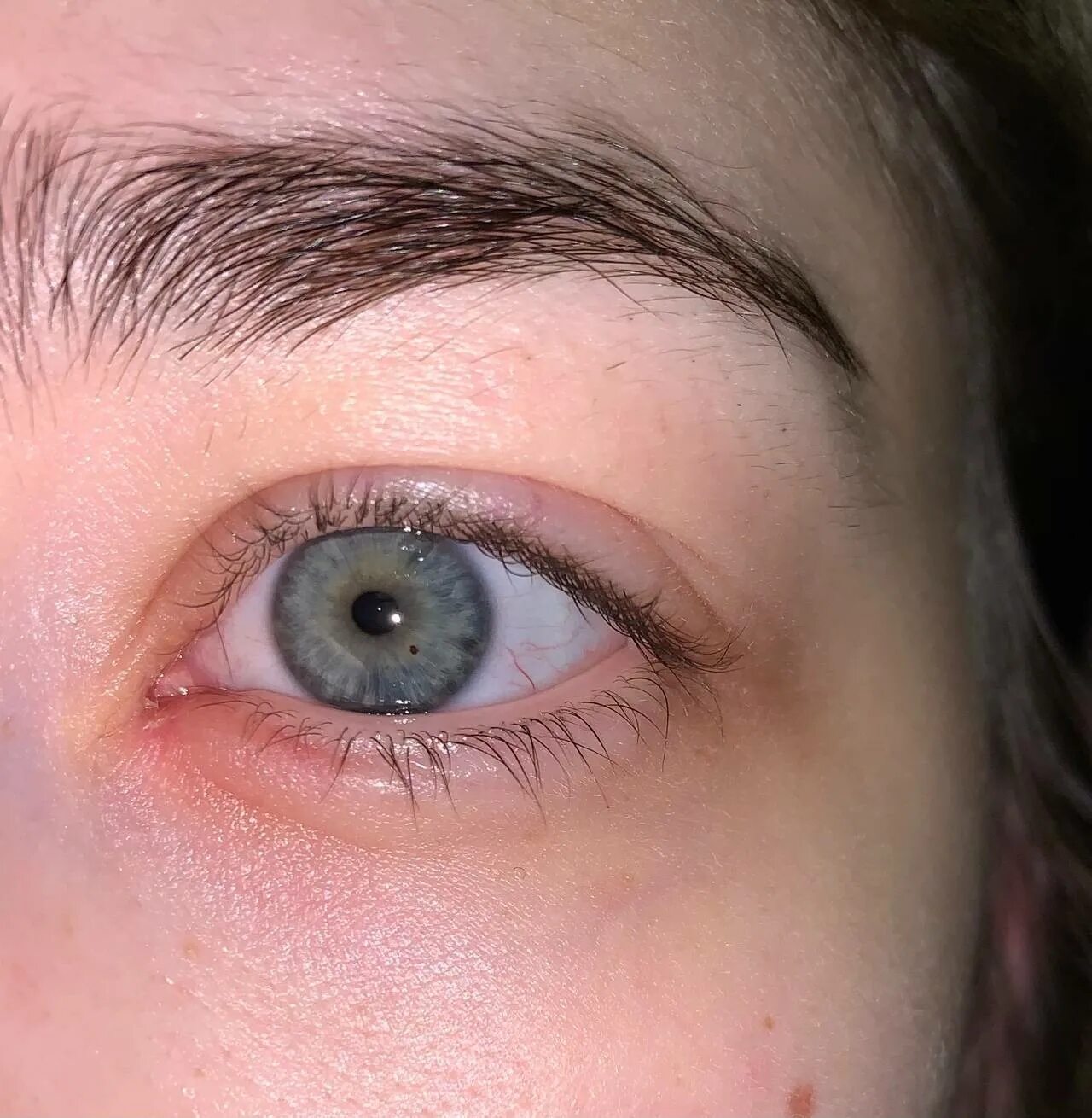 Лимбальный кератоконъюнктивит. Блефароптоз (опущение век). Развитое третье веко у человека. Полулунная складка (третье веко). Под 3 веком.