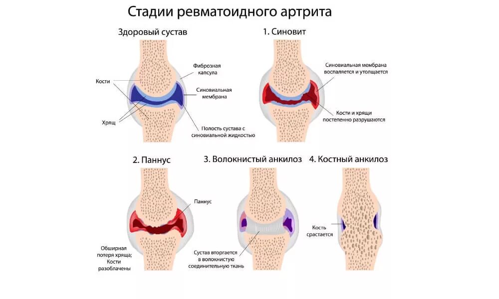 Ревматическое поражение суставов