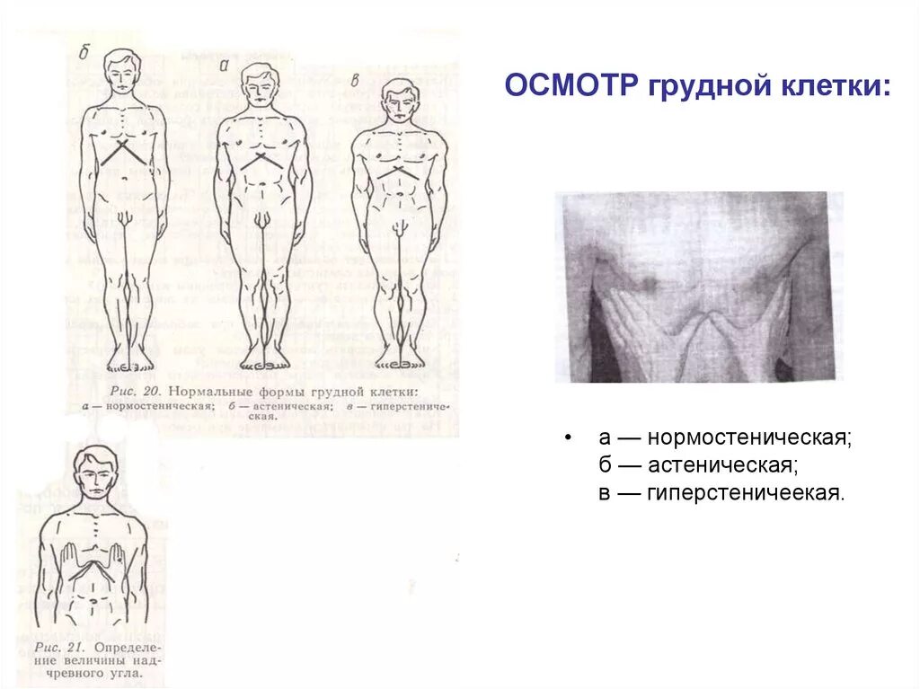 Формы грудной клетки нормостеническая астеническая. Формы грудной клетки пропедевтика. Форма грудной клетки у астеников. Патологические формы грудной клетки пропед. Грудная клетка у ребенка норма