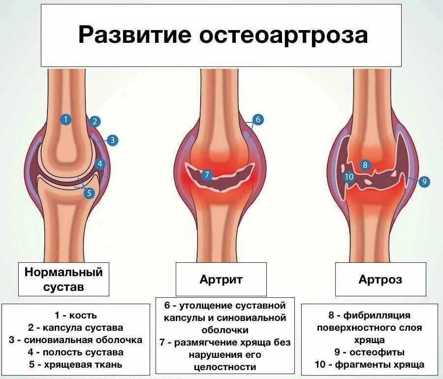 Артроз сколько времени. Классификация остеоартроза коленного сустава. деформирующий остеоартроз механизм развития. артроз 1 степени коленного сустава классификация. деформирующий гонартроз 1 степени коленного сустава.