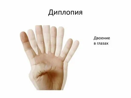Диплопия это