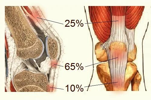 Тендинит сухожилия подколенной мышцы. Тендинит связки коленного сустава. Тендинит связки надколенника. Тендинопатия сухожилия коленного сустава.