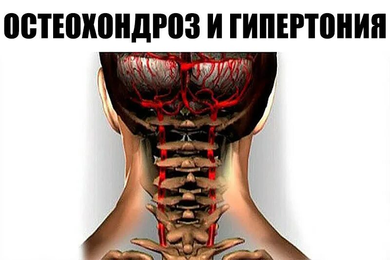 Давление при шейном хондрозе