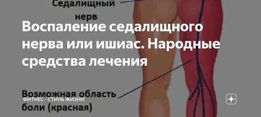 Сидальческий нерв лечение у мужчин. Седалищный нерв. Воспаление седалищного нерва. Защемление седалищного нерва. Воспаление ущемление седалищного нерва.