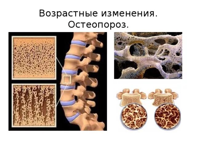 Возрастные изменения Кост. Возрастные изменения костей. Возрастные изменения в костях. Возрастные изменения костей и их соединения.