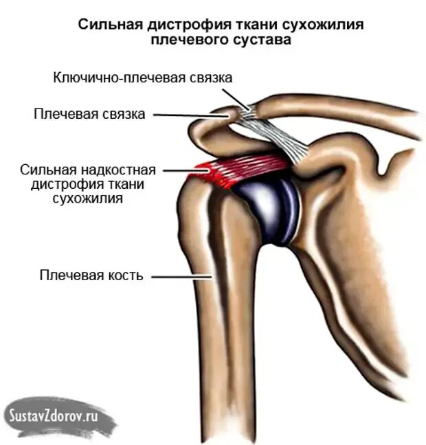 Болит рука при поднятии. Тендопатия сухожилия надостной мышцы. Тендинит надостной мышцы плечевого сустава. Тендинит сухожилия плеча. Кальцинирующий тендинит сухожилия надостной мышцы.