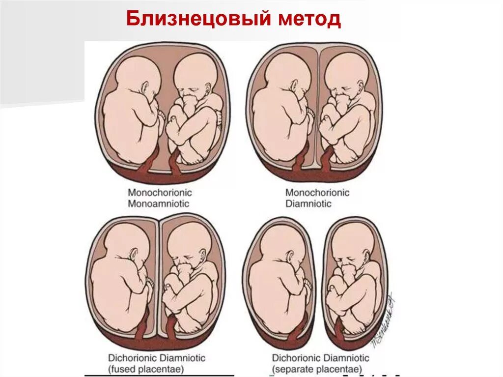 Двойная ди ди. Монохориальная диамниотическая многоплодная беременность. Беременность дихориальная диамниотическая двойня. Монохориальная беременность двойней. Монохориальная моноамниотическая Близнецы.