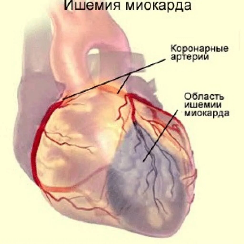 Коронарная ишемия. Ишемическая болезнь инфаркт миокарда. Острая ишемия миокарда. Ишемия стенка миокарда.