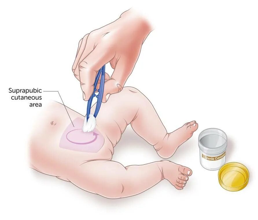 Не могу пописать первая помощь. Сбор мочи у грудничка девочки. Для сбора анализа мочи у грудничков. Баночка для сбора мочи у младенцев. Сбор мочи у новорожденных мальчиков мочеприемник.