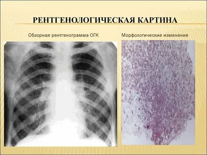 Рентгенологическая картина