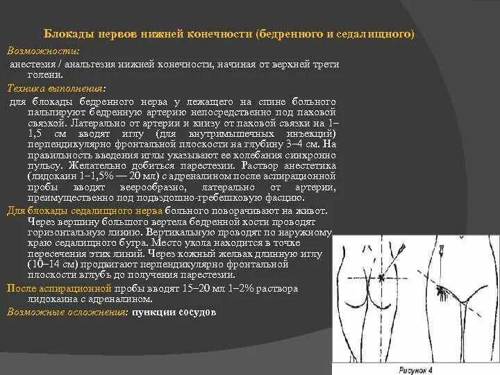 Блокады половые. Техника блокады наружного кожного нерва бедра. Проводниковая анестезия седалищного нерва. Проводниковая анестезия бедренного нерва. Проводниковая анестезия бедренного и запирательного нервов..