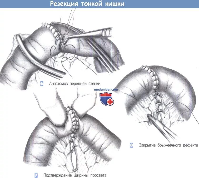 Операция толстой. Резекция кишки с анастомозом. Операция резекция тонкой кишки. Этапы операции резекции тонкой кишки. Резекция и анастомоз кишечника.
