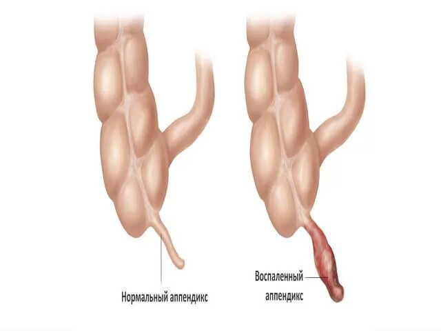 Аппендицит норма. Острый флегмонозный аппендикс. Флегмонозный аппендицит. Катаральный аппендицит. Острый катаральный аппендицит.