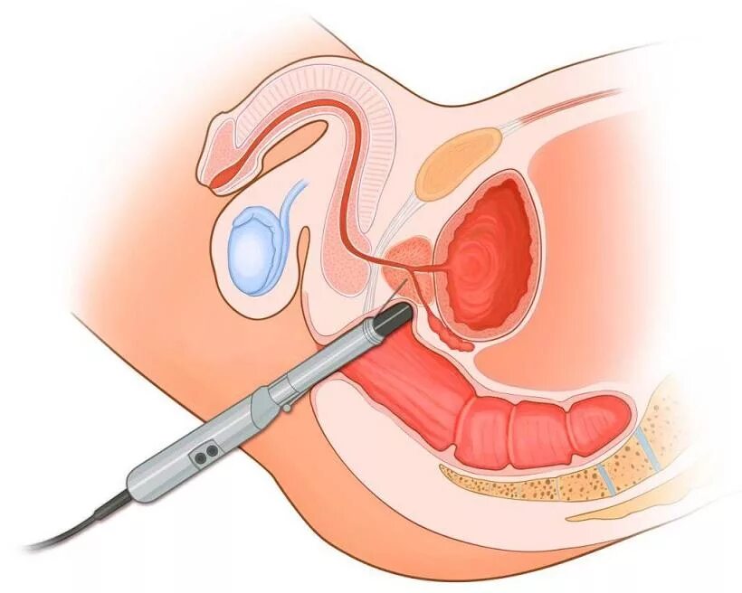 Трузи предстательной железы подготовка к исследованию. Ультразвуковое исследование предстательной железы трансректальное. Трансректальное УЗИ простаты. Трансректальный датчик УЗИ. УЗИ предстательной железы трансректально.