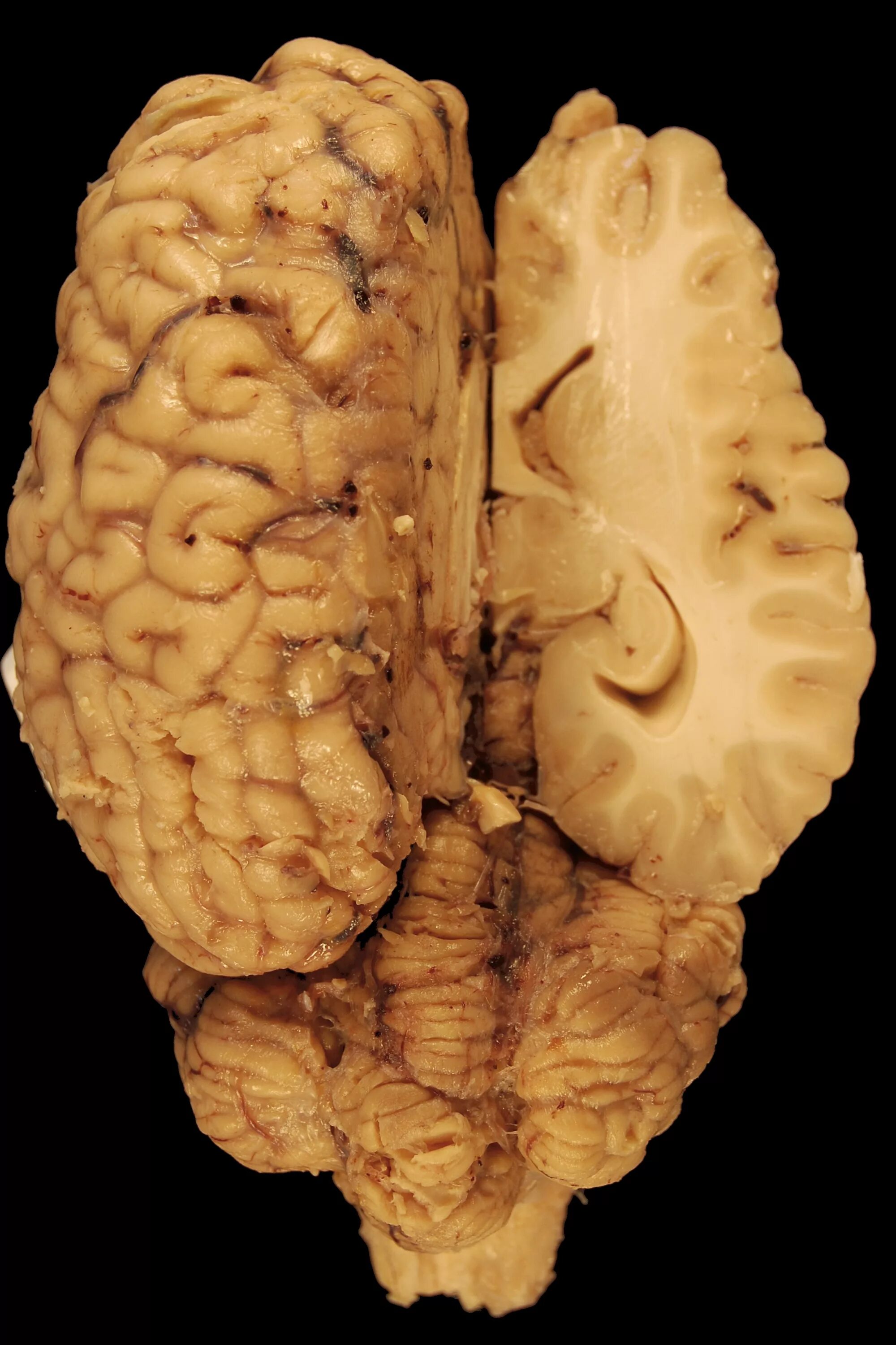 Головной мозг живой. Нейрофиброматоз мозжечок.