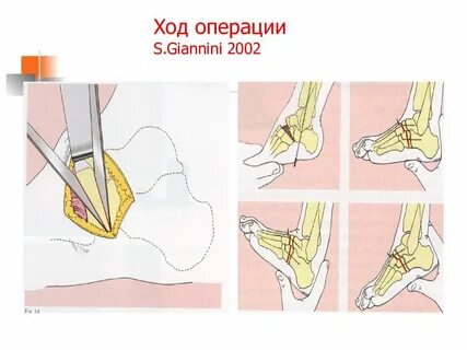 Операции при дцп