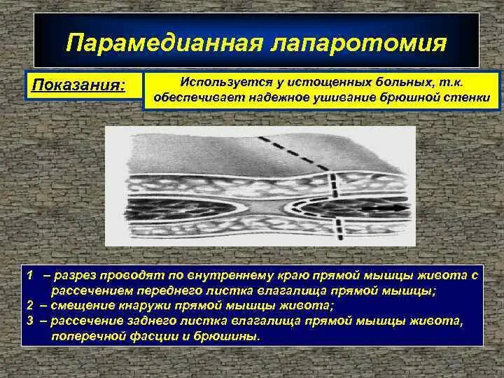 Лапаротомия что это такое простыми словами. Парамедианная лапаротомия. Парамедианная трансректальная лапаротомия. Трансректальная лапаротомия разрез.