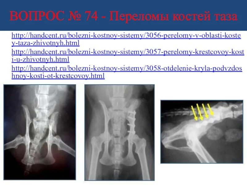 История болезни перелом костей