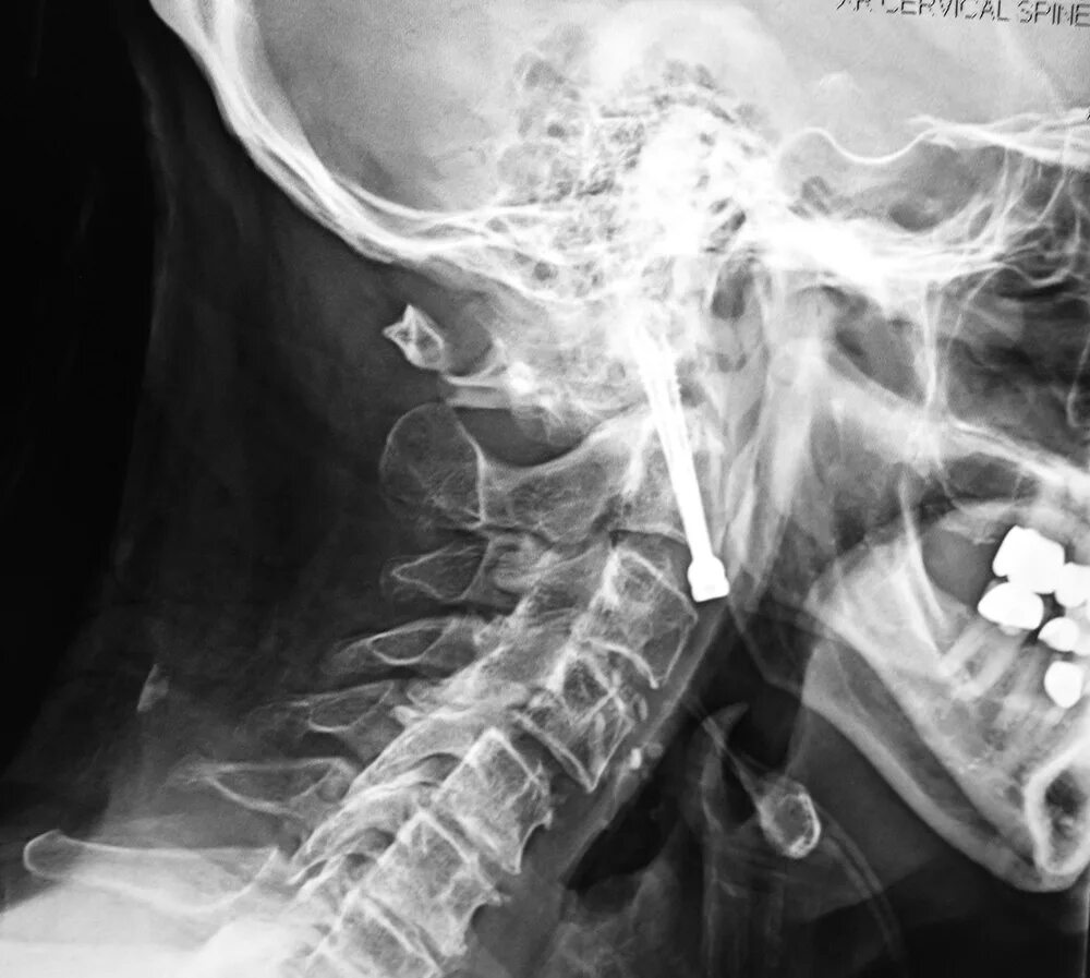 Fracture c