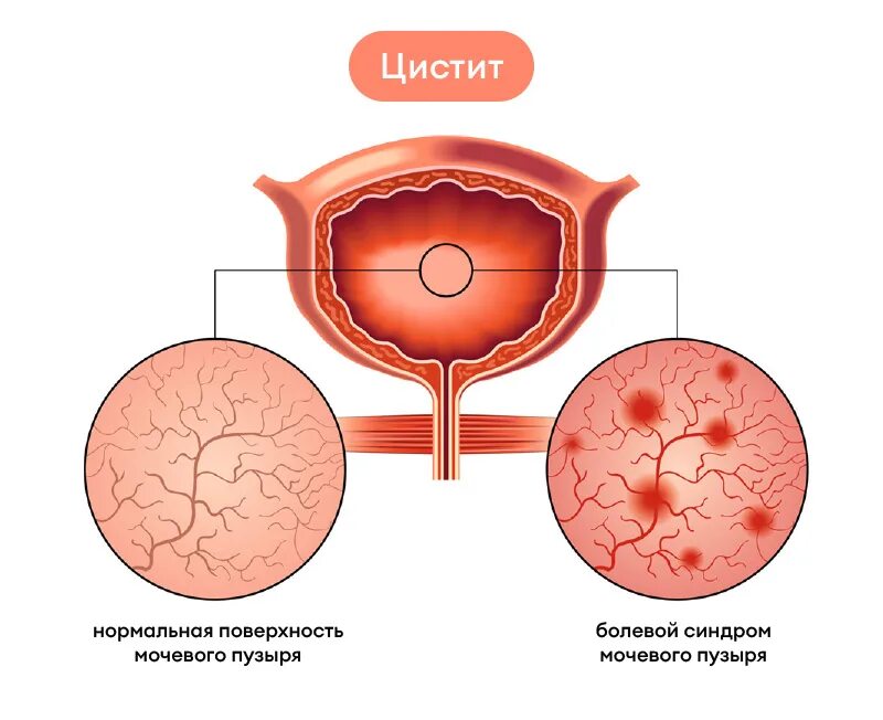 Цистит интерстициальный симптомы у женщин и лечение. Интерстициальный цистит. Хронический интерстициальный цистит. Интерстициальный цистит у женщин.