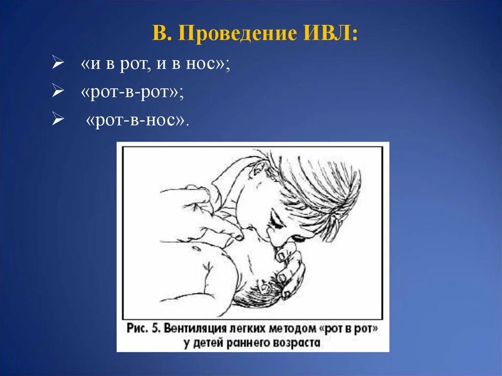 Способ рот в нос. Проведение ИВЛ рот в нос. Вентиляция легких рот в нос.