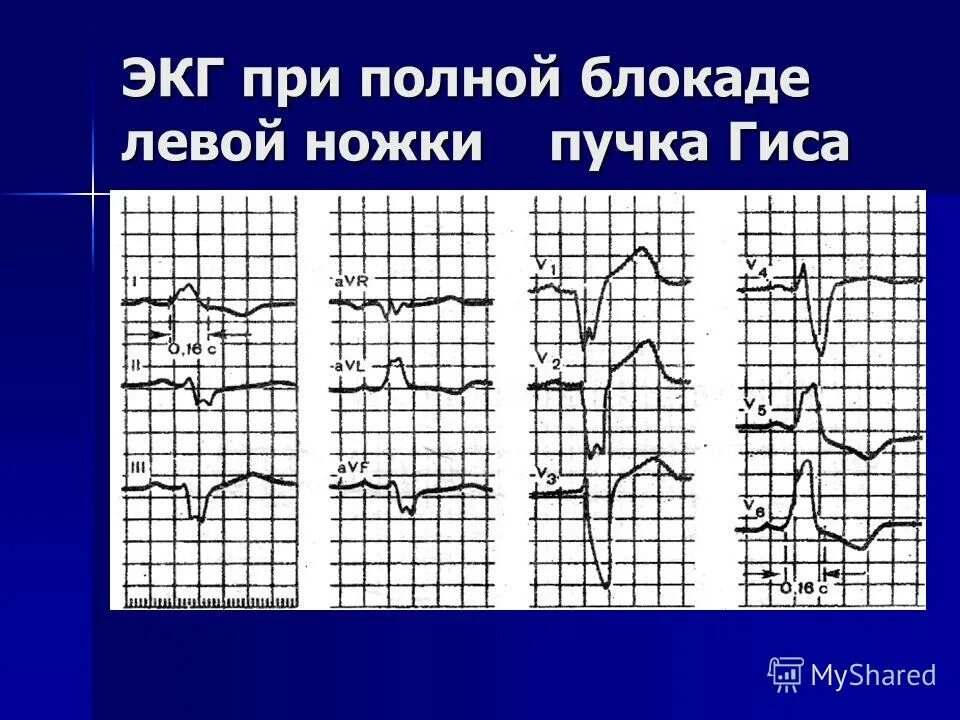 Блокада левой ножки п гиса