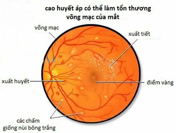 Гипертоническая ангиопатия сетчатки. Гипертоническая ретинопатия глазное дно. Гипертоническая ангиопатия и ретинопатия. Ретинопатия гипертоническая болезнь.