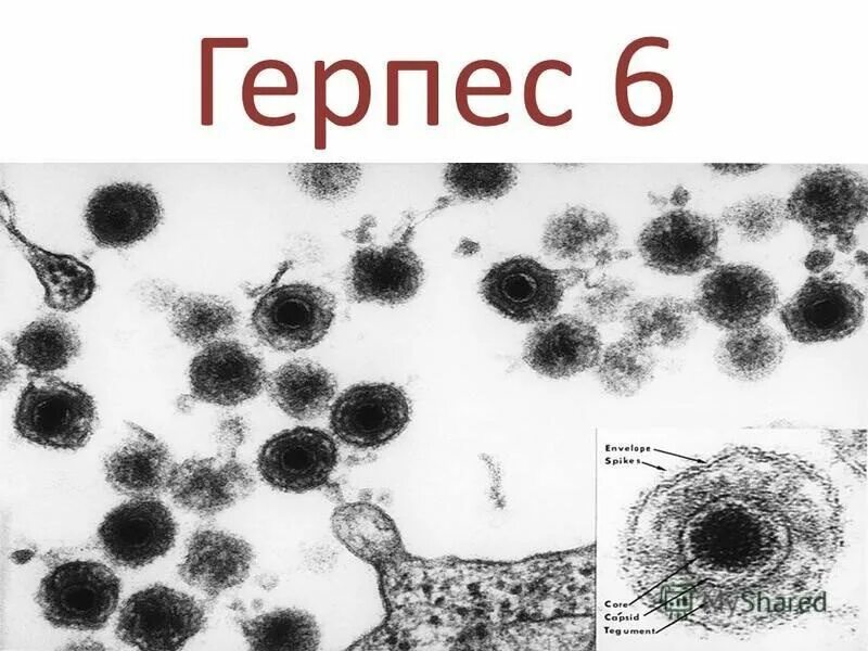 Вирус герпеса 6 типа. Вируса герпеса 6 типа (hhv6. Herpes virus 6