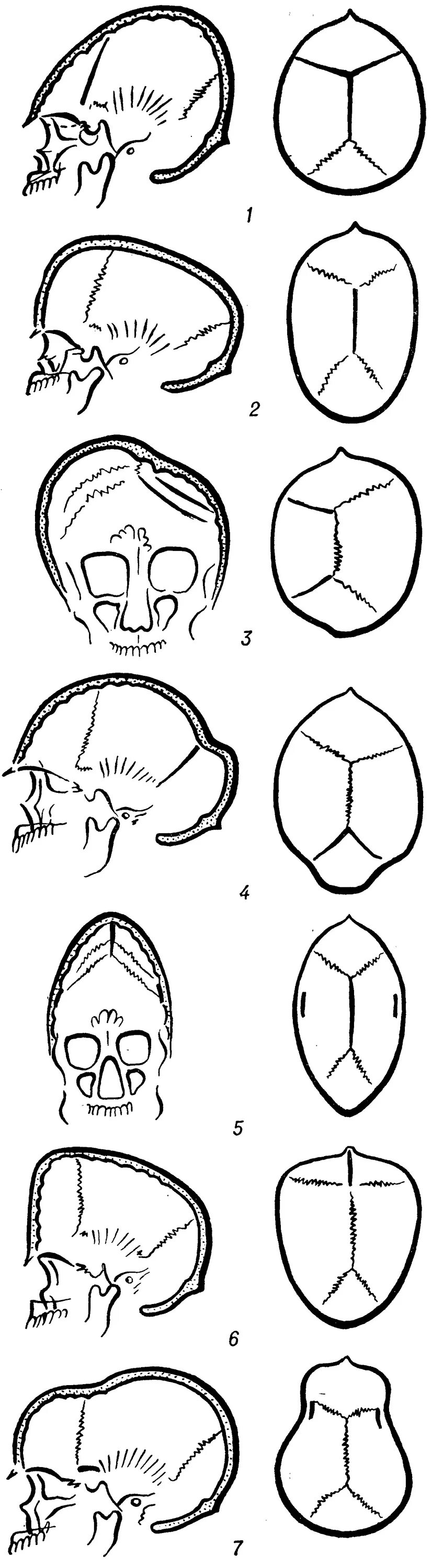 Варианты формы черепа. Краниостеноз формы черепа. Краниостеноз костей черепа. Раннее сращение костей черепа. Синостоз костей черепа.