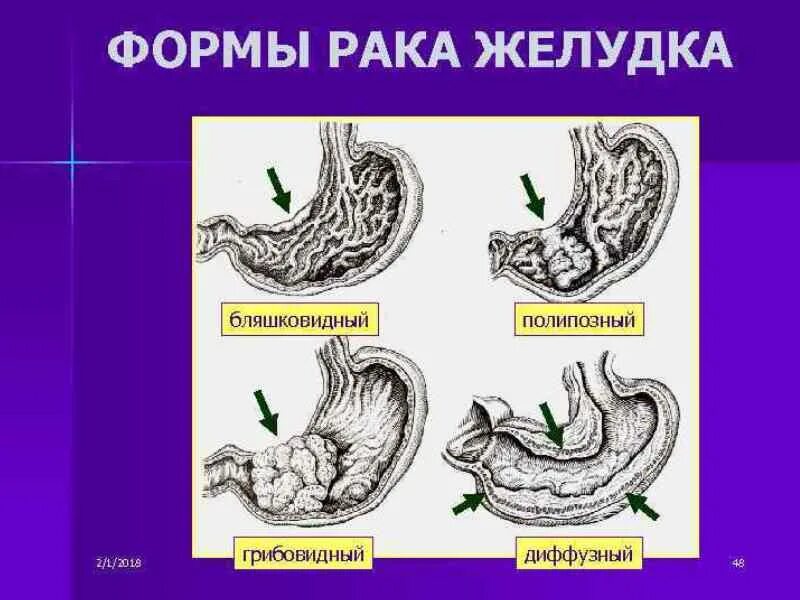 Формы рака желудка