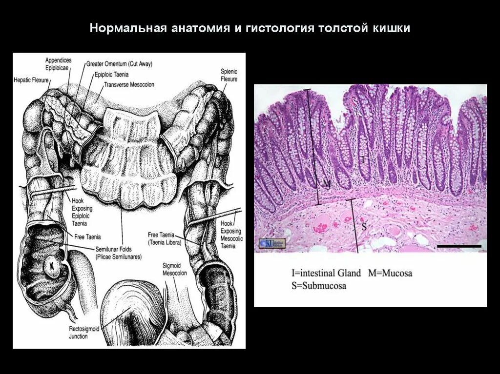 Ободочная кишка гистология. Илеоцекальный клапан слепая кишка. Препарат толстого кишечника гистология. Отделы толстого кишечника анатомия. Эпителий сигмовидной кишки.