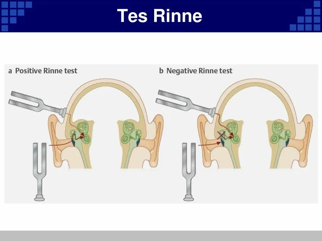 Исследование слуха камертонами опыт Ринне опыт Швабаха Вебера. Исследование костной и воздушной проводимости звука. Опыт Ринне: исследование воздушной проводимости. Опыт Ринне Камертон.