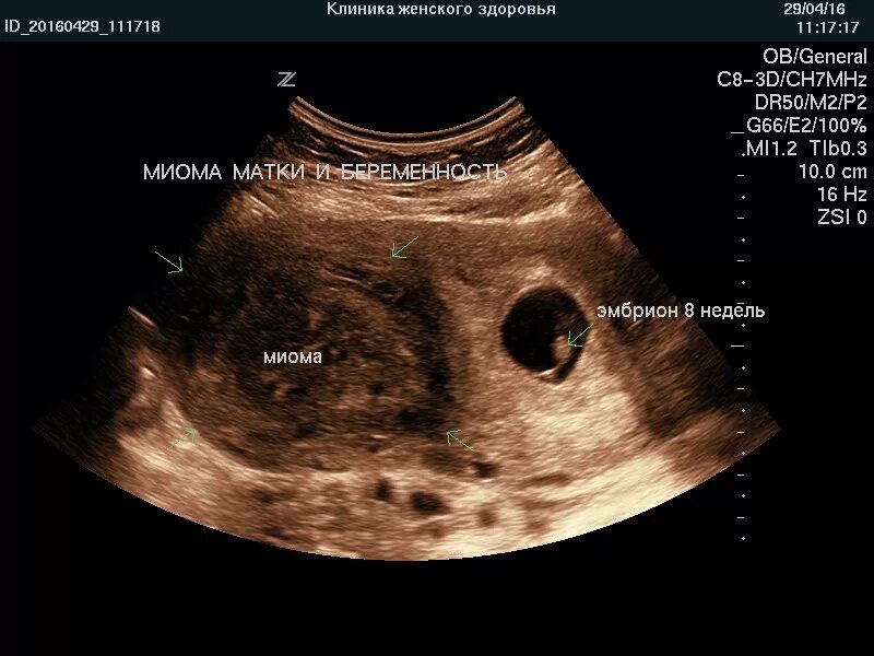 Шеечная миома матки УЗИ. УЗИ матки беременность. Матка 25 мм