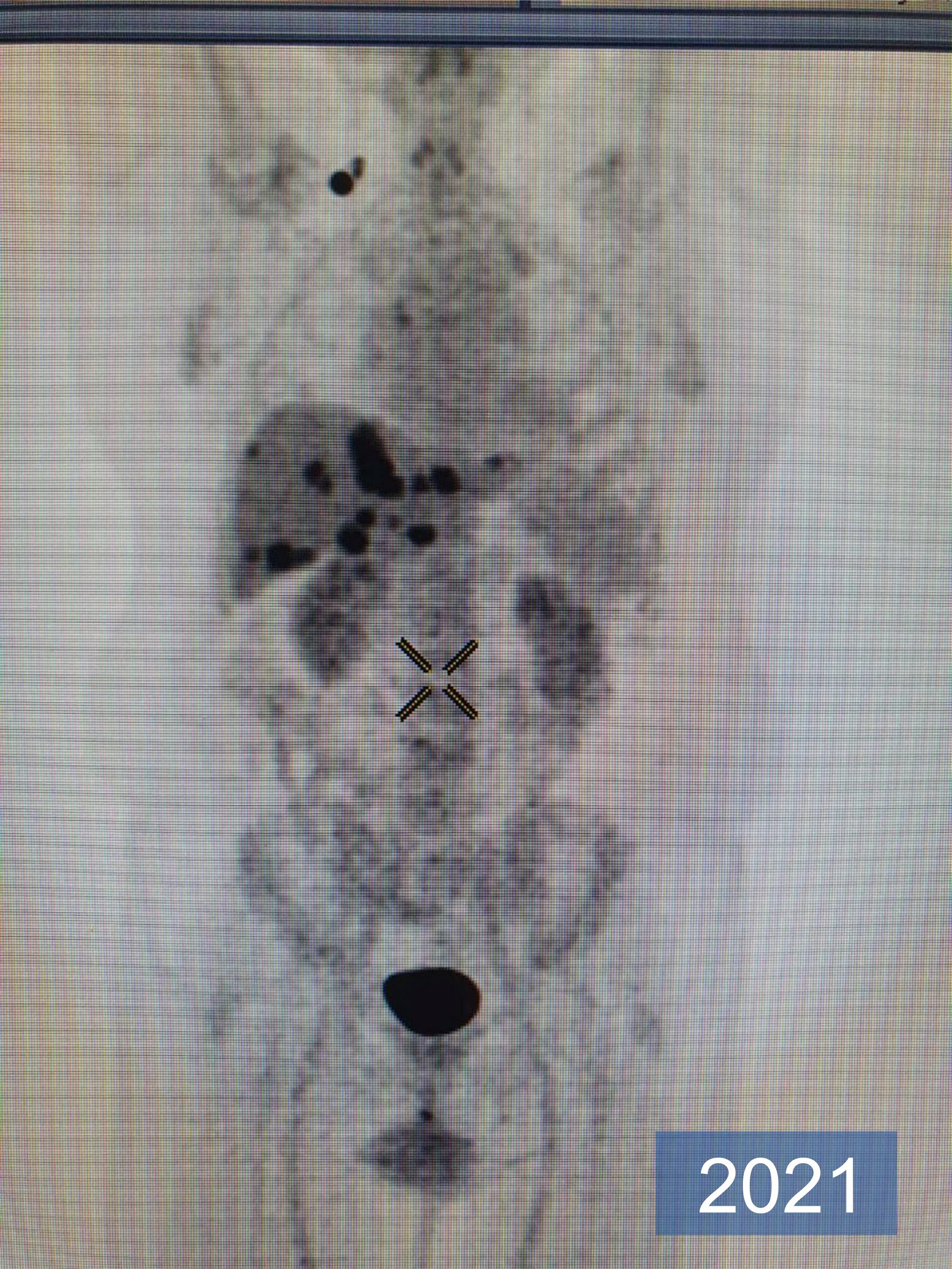 Pet ct iaea. Пэт кт описание результатов. Оссификация желтой связки на кт. Ядерная медицина. Пэт кт исследование онкология.