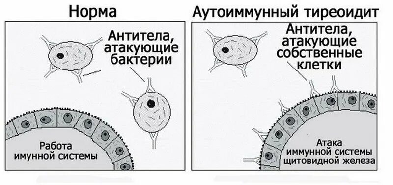 Атакующие клетки. Тиреоидит Хашимото патогенез. Аутоиммунный тиреоидит щитовидной железы что это такое. Заболевание щитовидной железы тиреоидит. Симптомы тиреоидита щитовидной железы.