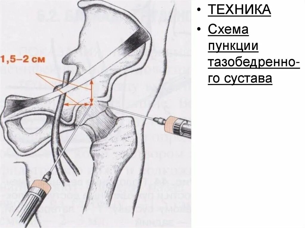 Пункция тазобедренного сустава техника. Техника пункции и тазобедренного сустава сустава. Методика пункции тазобедренного сустава. Пункции суставов плечевой сустав. Пункция через задний свод