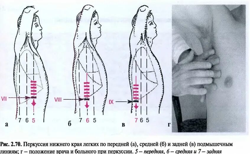 Парастернальная линия грудной клетки. Топографические линии грудной клетки пропедевтика. 2 межреберье слева от грудины какой клапан. Опознавательные линии грудной клетки. Топографические линии грудной клетки схема.