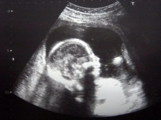 18 неделя близнецов. УЗИ 18 недель беременности.