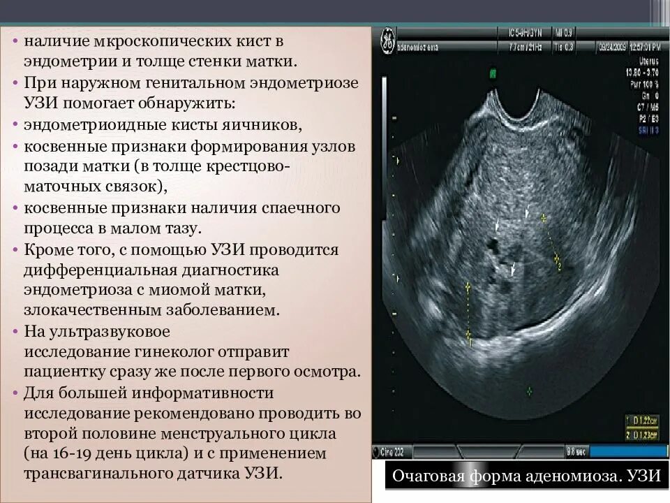 Киста уменьшается в размере. Эндометриоз яичников на узи. эндометриома узи картина. эндометриоидная киста яичника на узи. эндометриоз яичника на узи.