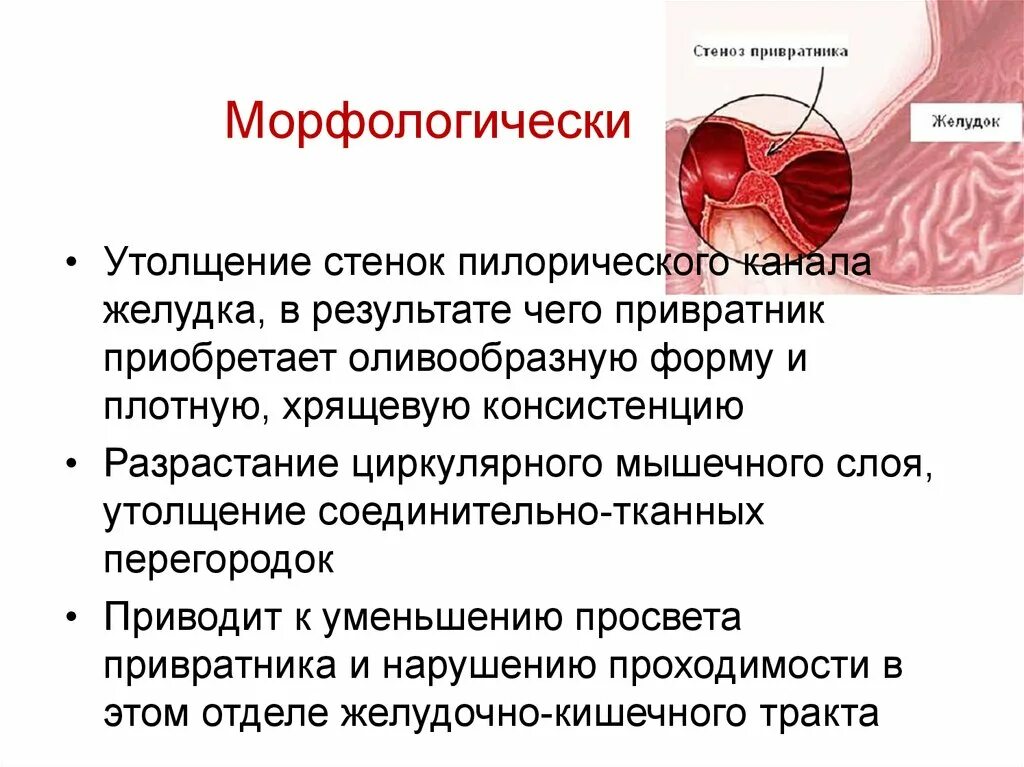 Синдром стеноза. Стеноз привратника причины. Признаки стеноза привратника. Симптомы декомпенсированного стеноза привратника. Симптомы характерные для стеноза привратника.