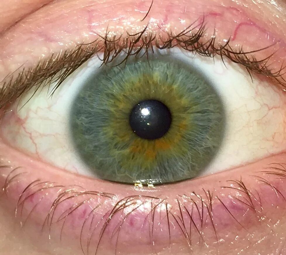 Центральная гетерохромия глаз. Гетерохромия радужной оболочки. Центральная гетерохромия голубой Карий зелёный. Гетерохромия центральной Радужки.