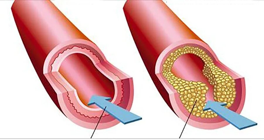 Сужение сосудов симптомы причины. Атеросклеротическая бляшка. Атеросклеротическое поражение сосудов. Холестериновые бляшки в сосудах.