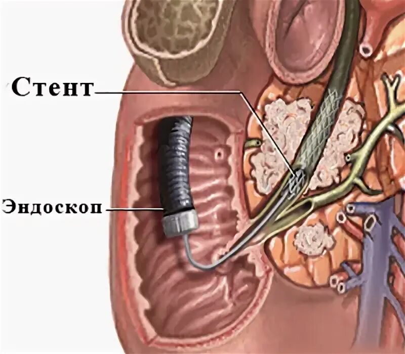 Стентирование вирсунгова протока поджелудочной железы. Эндоскопическое стентирование желчного протока. Эндоскопическое стентирование панкреатического протока. Эндоскопическое стентирование протока поджелудочной железы. Стент желчного протока